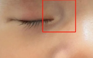 新生儿眼睛下面有条沟是正常生理现象还是异常信号？需警惕哪些潜在问题？