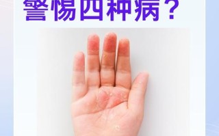 儿童手脱皮是缺乏维生素还是皮肤病？