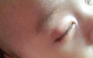 新生儿眼部血管瘤有哪些典型症状？家长该如何早期识别与应对？