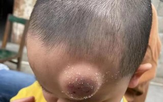 新生儿头上有血包图片正常吗？需要担心吗？