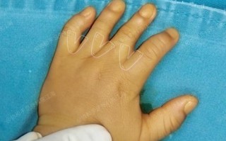 新生儿大拇指并指图片，这种先天畸形需要手术矫正吗？