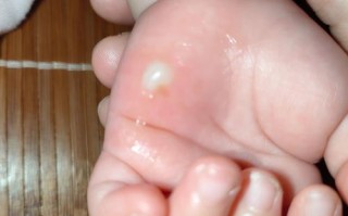 新生儿盐泡的具体形态和形成过程是怎样的？会对婴儿皮肤产生哪些影响？