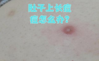 孕期肚子长痘痘是激素变化还是皮肤问题？