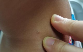 儿童颈部2-3cm淋巴结要紧吗？