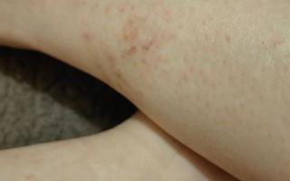 孕期脚脖子痒，是皮肤问题还是激素变化？需要警惕哪些孕期特殊疾病？