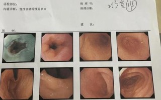 怀孕期间做了无痛肠镜，会对胎儿或孕妇造成哪些影响？