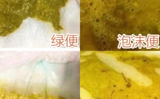 新生儿出生后排便但无小便，是正常生理现象还是异常信号？