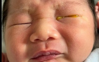 新生儿泪腺不通导致流出血水，这正常吗？需要如何处理？