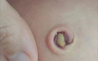 新生儿肚脐脱落后突出是正常现象还是异常信号？需要警惕哪些问题？