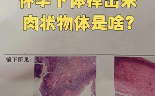 孕期下面有坨肉堵住是何原因？会对分娩造成影响吗？