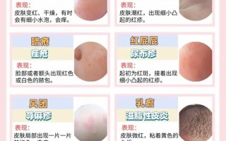 新生儿湿疹和痤疮区别