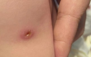 新生儿打预防针后伤口化脓了怎么办？需要处理吗？