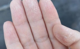 10岁孩子手脱皮，是缺乏营养还是生病了？