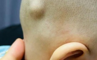 新生儿头上突然出现硬包是正常现象还是疾病信号？需要立即就医吗？