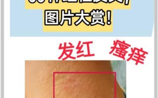 儿童神经性皮炎严重吗