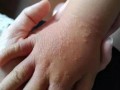 儿童手上起小疙瘩图片对照，这到底是什么原因引起的呢？