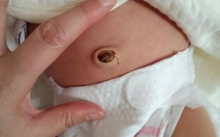 新生儿肚脐内白色物质是何物？