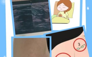 孕期腋窝突然摸到肿块，是孕期正常变化还是需要警惕的信号？