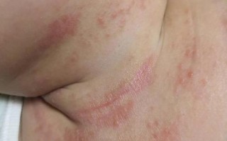 新生儿第二天细菌感染