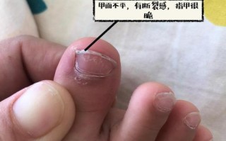 新生儿脚趾甲长肉里咋办？
