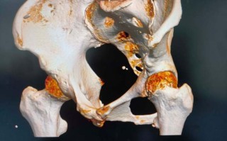 13岁儿童股骨颈骨折该如何治疗？后续康复与发育风险大吗？