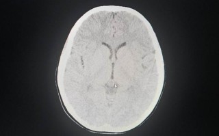 儿童松果体肿瘤治愈能活多久