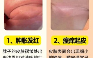 新生儿脖子淹破皮，如何正确护理处理？