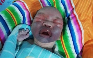 新生儿颜面挤压综合征，产道挤压会导致面部畸形吗？如何预防与处理？