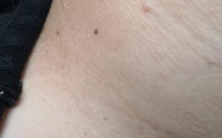 孕期皮赘产后会自行脱落吗？