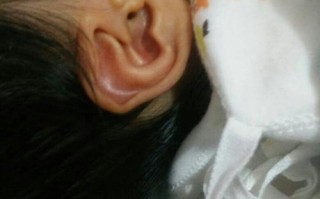 新生儿耳朵旁长小肉丁是什么？需要治疗吗？会自己消失吗？