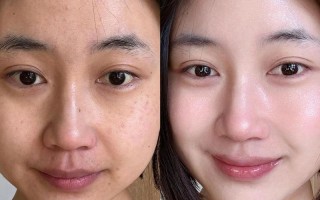 怀孕期间皮肤发黄是什么原因？该如何改善才能恢复健康光泽？