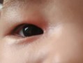 新生儿眼皮红印是什么原因？需要担心吗？