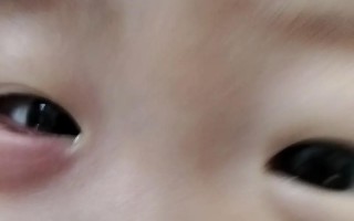 新生儿眼睛充血是正常现象还是异常信号？需要关注哪些潜在风险？