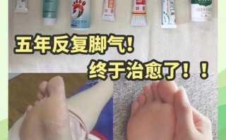 备孕期可以抹脚气膏吗