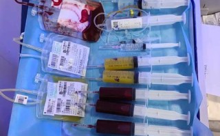 新生儿换血治疗究竟是什么？为何需要这种高风险操作？