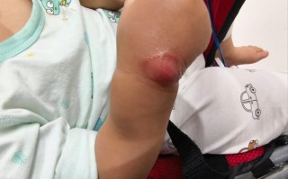 新生儿硬肿症的并发症