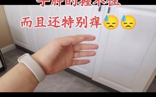 孕期手肿发痒是正常现象吗？需警惕哪些潜在健康问题？