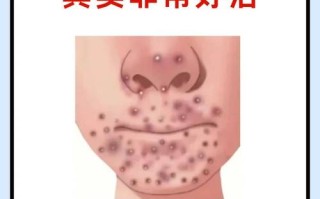 孕期下巴长痘是激素变化还是其他原因？