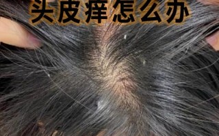怀孕期间头皮奇痒难忍，到底该怎么办才安全有效？