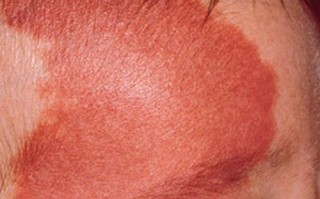 新生儿红色胎记会自行消退吗？需要治疗吗？家长该如何科学护理？