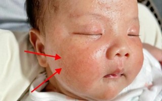 新生儿服用黄疸药后出现哪些症状需警惕？是否为药物正常反应？