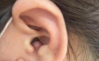 新生儿耳朵里的小包是什么？需要治疗吗？会影响听力发育吗？