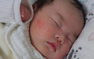 新生儿额头长满小红点是湿疹还是其他皮肤问题？需要治疗吗？