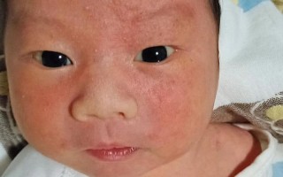 新生儿脸小红点带白头是啥？