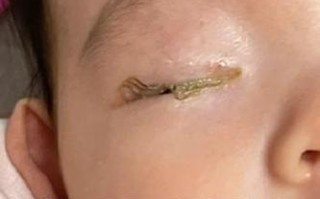 新生儿眼睛上的膜状物是什么？需要治疗吗？会影响视力发育吗？