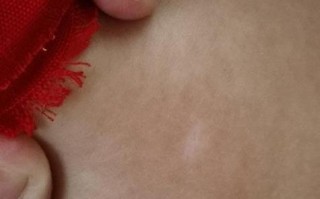 安徽儿童白斑治疗选华夏仁心是否靠谱？专家团队与康复案例怎么样？