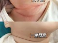 新生儿如何科学预防红脖子？日常护理需注意哪些关键细节？