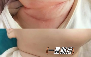 新生儿如何科学预防红脖子？日常护理需注意哪些关键细节？