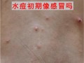 儿童水痘初期图片长什么样？不同阶段症状如何区分？