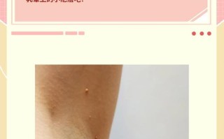 孕期乳晕长了小肉疙瘩